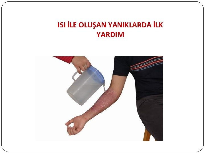 ISI İLE OLUŞAN YANIKLARDA İLK YARDIM 