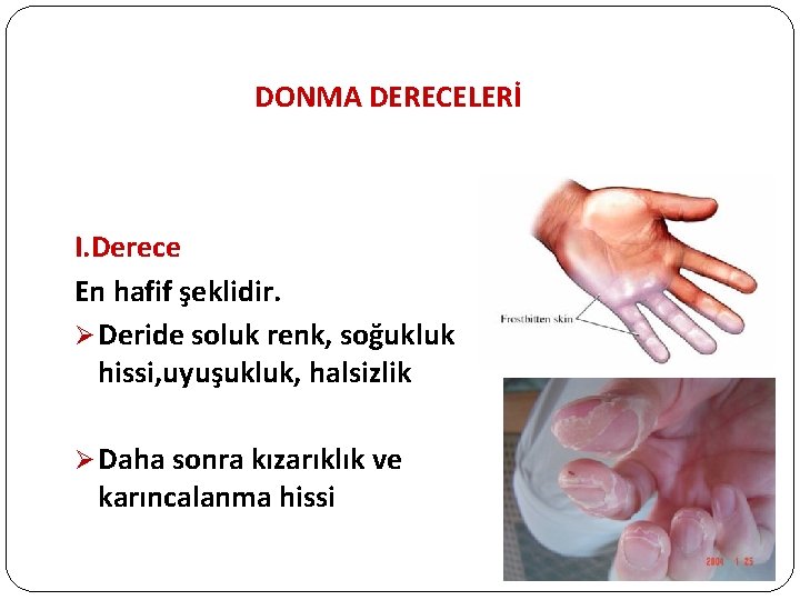 DONMA DERECELERİ I. Derece En hafif şeklidir. Ø Deride soluk renk, soğukluk hissi, uyuşukluk,