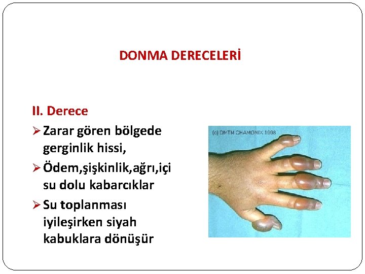 DONMA DERECELERİ II. Derece Ø Zarar gören bölgede gerginlik hissi, Ø Ödem, şişkinlik, ağrı,