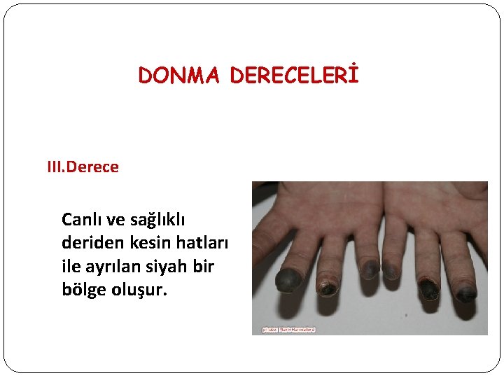 DONMA DERECELERİ III. Derece Canlı ve sağlıklı deriden kesin hatları ile ayrılan siyah bir