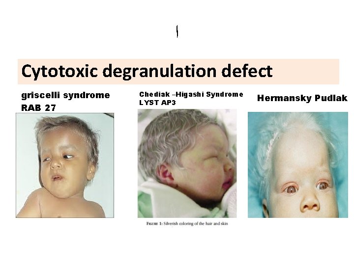  ﺍ Cytotoxic degranulation defect griscelli syndrome RAB 27 Chediak –Higashi Syndrome LYST AP