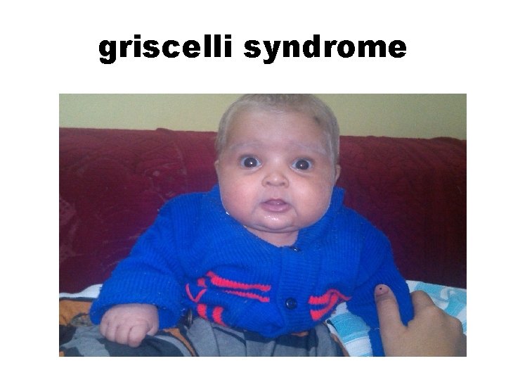 griscelli syndrome 