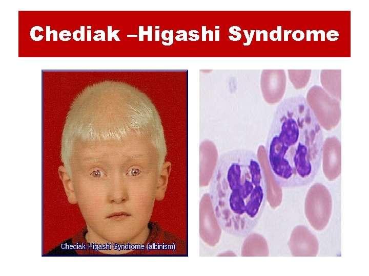 Chediak –Higashi Syndrome 