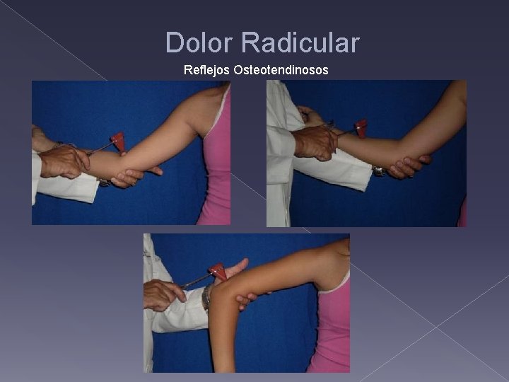 Dolor Radicular Reflejos Osteotendinosos 