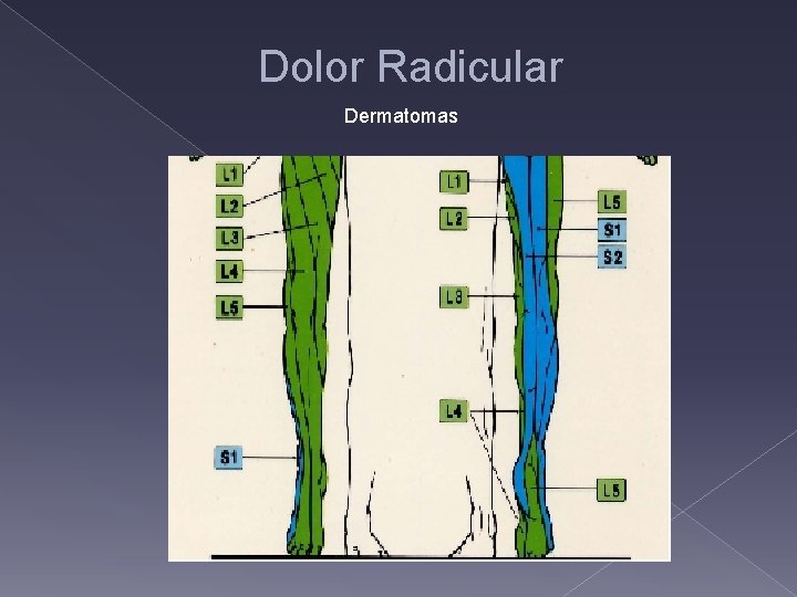 Dolor Radicular Dermatomas 