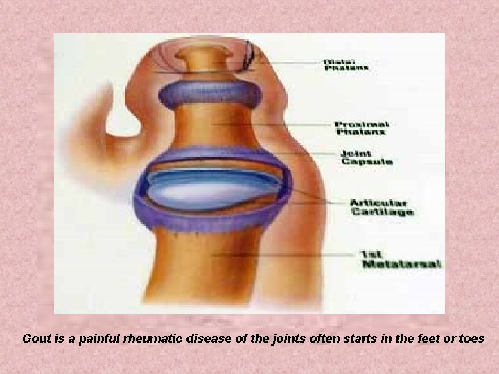 Gout is a painful rheumatic disease of the joints often starts in the feet