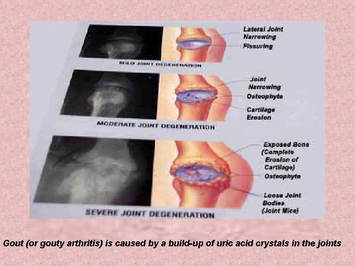 Gout (or gouty arthritis) is caused by a build-up of uric acid crystals in