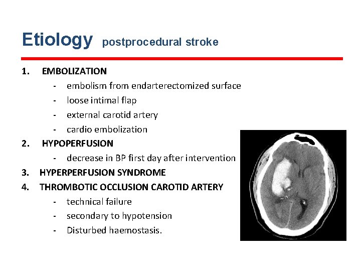 Etiology 1. 2. 3. 4. postprocedural stroke EMBOLIZATION - embolism from endarterectomized surface -