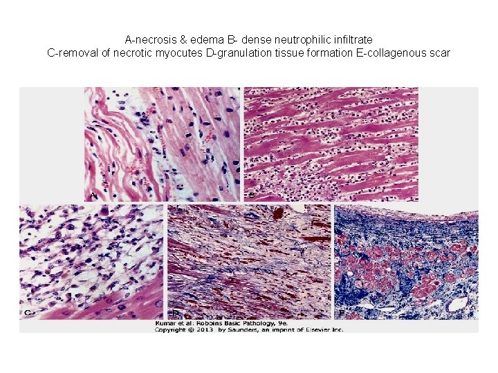 A-necrosis & edema B- dense neutrophilic infiltrate C-removal of necrotic myocutes D-granulation tissue formation