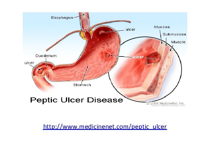 http: //www. medicinenet. com/peptic_ulcer 