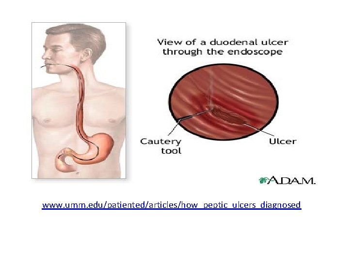 www. umm. edu/patiented/articles/how_peptic_ulcers_diagnosed 