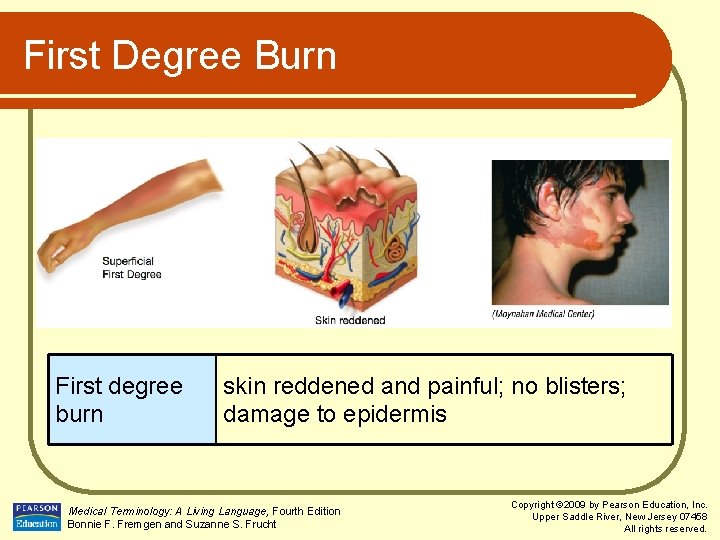 First Degree Burn First degree burn skin reddened and painful; no blisters; damage to