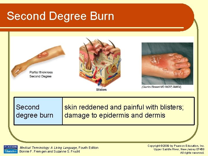 Second Degree Burn Second degree burn skin reddened and painful with blisters; damage to