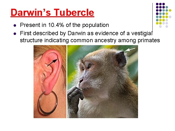 Darwin’s Tubercle l l Present in 10. 4% of the population First described by Darwin’s Tubercle l l Present in 10. 4% of the population First described by