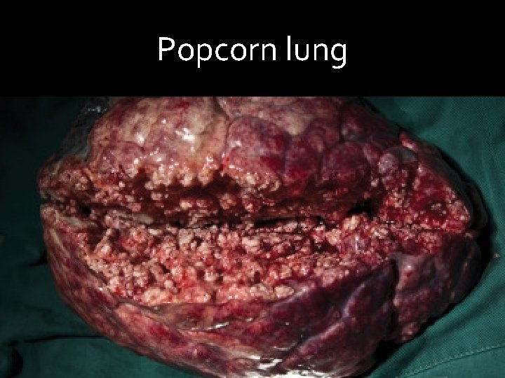 Popcorn lung 