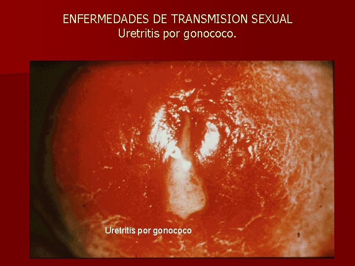 ENFERMEDADES DE TRANSMISION SEXUAL Uretritis por gonococo 