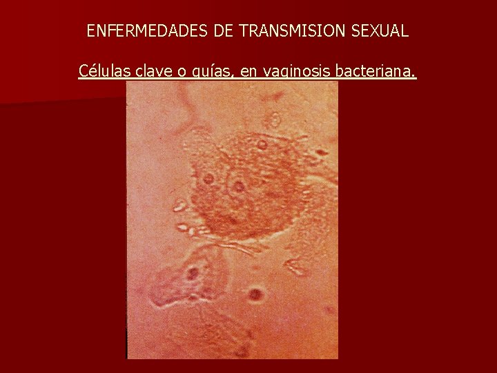 ENFERMEDADES DE TRANSMISION SEXUAL Células clave o guías, en vaginosis bacteriana. 