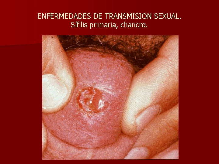 ENFERMEDADES DE TRANSMISION SEXUAL. Sífilis primaria, chancro. 
