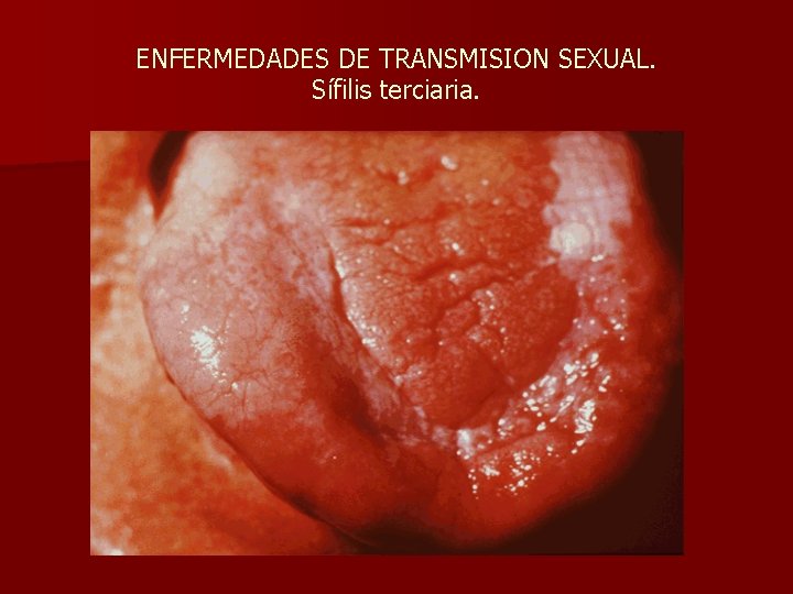ENFERMEDADES DE TRANSMISION SEXUAL. Sífilis terciaria. 