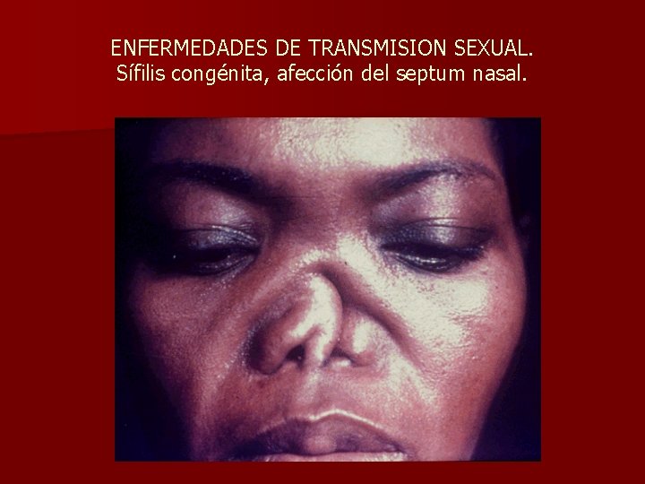 ENFERMEDADES DE TRANSMISION SEXUAL. Sífilis congénita, afección del septum nasal. 