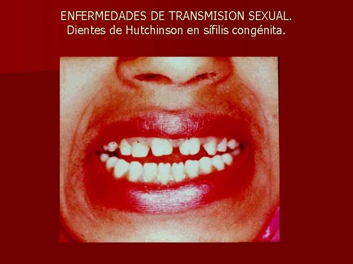 ENFERMEDADES DE TRANSMISION SEXUAL. Dientes de Hutchinson en sífilis congénita. 