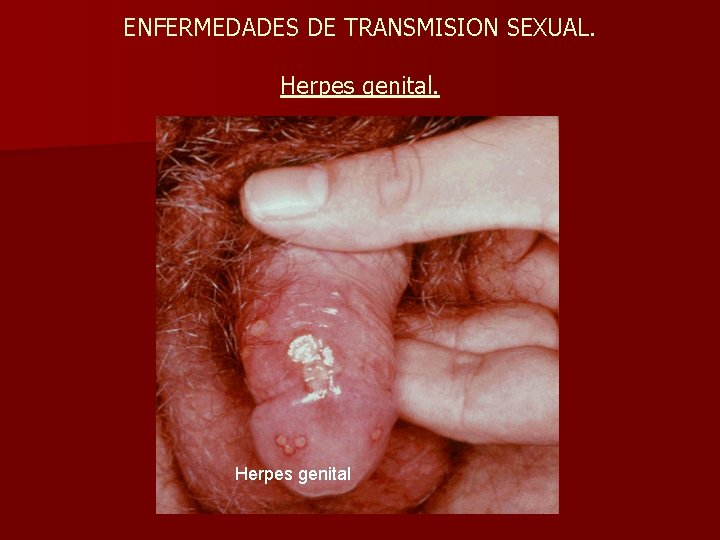 ENFERMEDADES DE TRANSMISION SEXUAL. Herpes genital 