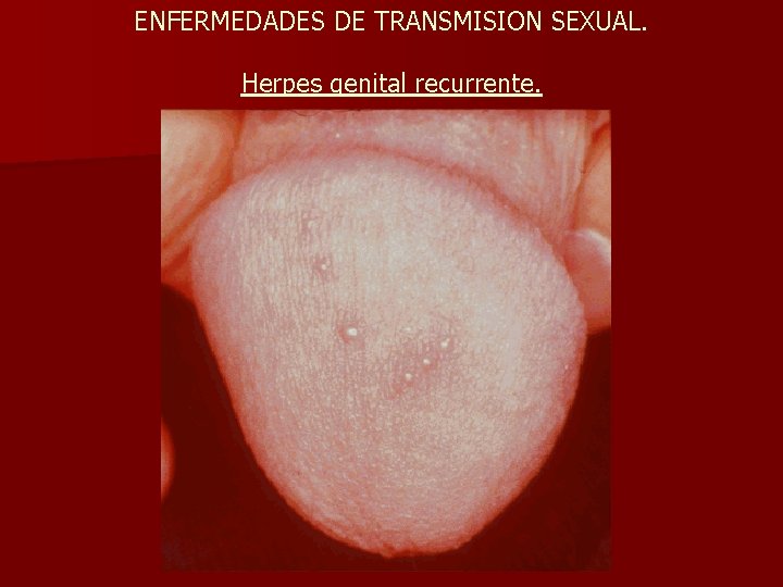 ENFERMEDADES DE TRANSMISION SEXUAL. Herpes genital recurrente. 