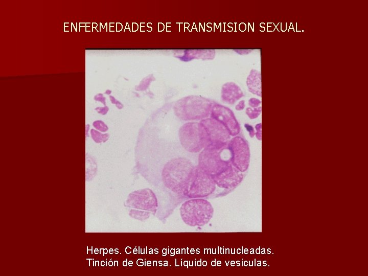 ENFERMEDADES DE TRANSMISION SEXUAL. Herpes. Células gigantes multinucleadas. Tinción de Giensa. Líquido de vesículas.