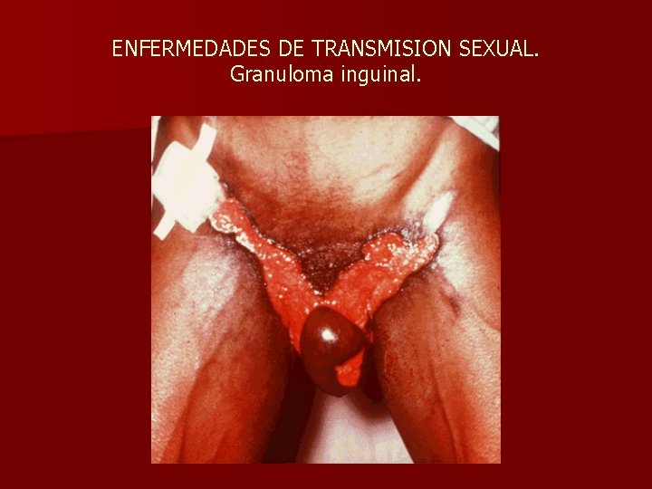 ENFERMEDADES DE TRANSMISION SEXUAL. Granuloma inguinal. 