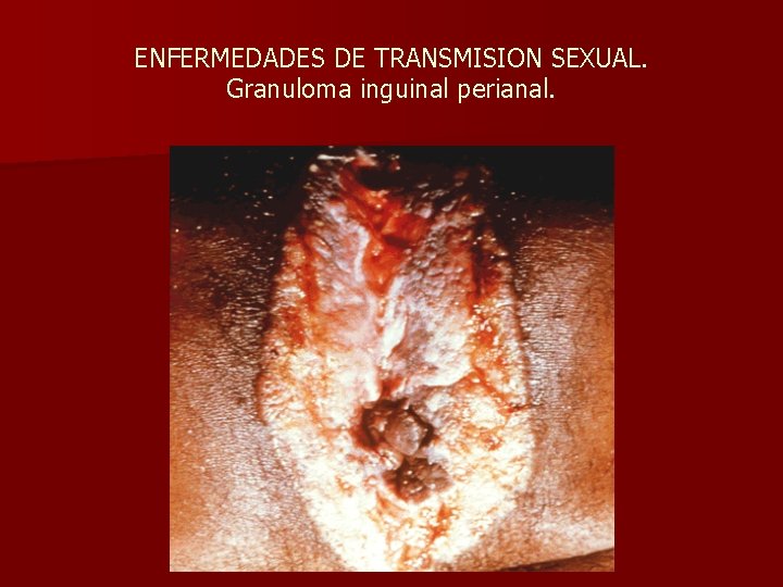 ENFERMEDADES DE TRANSMISION SEXUAL. Granuloma inguinal perianal. 