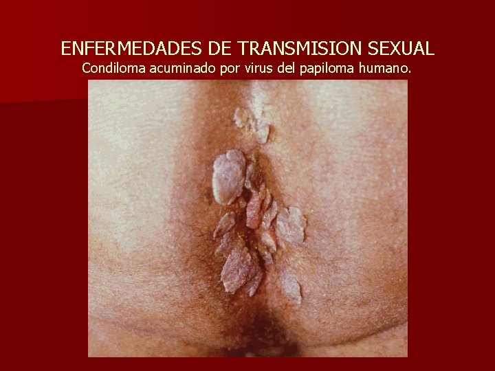 ENFERMEDADES DE TRANSMISION SEXUAL Condiloma acuminado por virus del papiloma humano. 