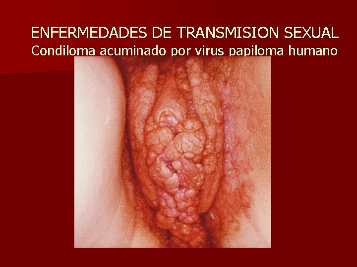 ENFERMEDADES DE TRANSMISION SEXUAL Condiloma acuminado por virus papiloma humano 