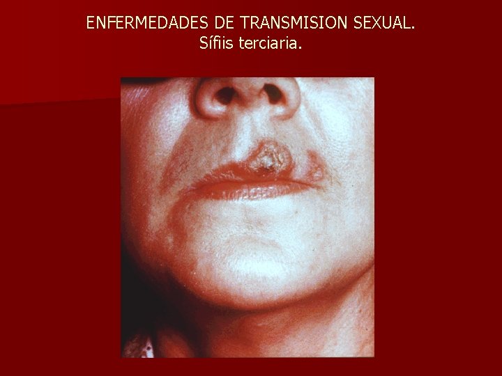ENFERMEDADES DE TRANSMISION SEXUAL. Sífiis terciaria. 