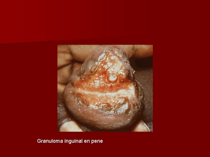 Granuloma inguinal en pene 