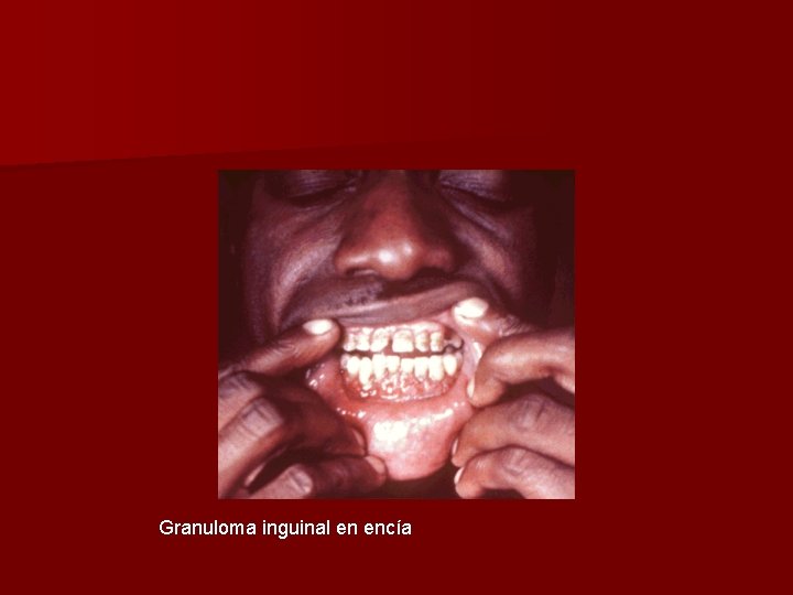 Granuloma inguinal en encía 