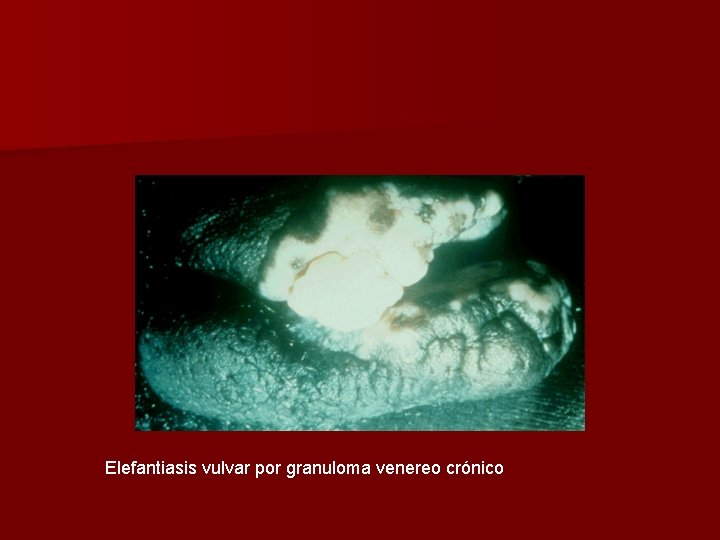 Elefantiasis vulvar por granuloma venereo crónico 
