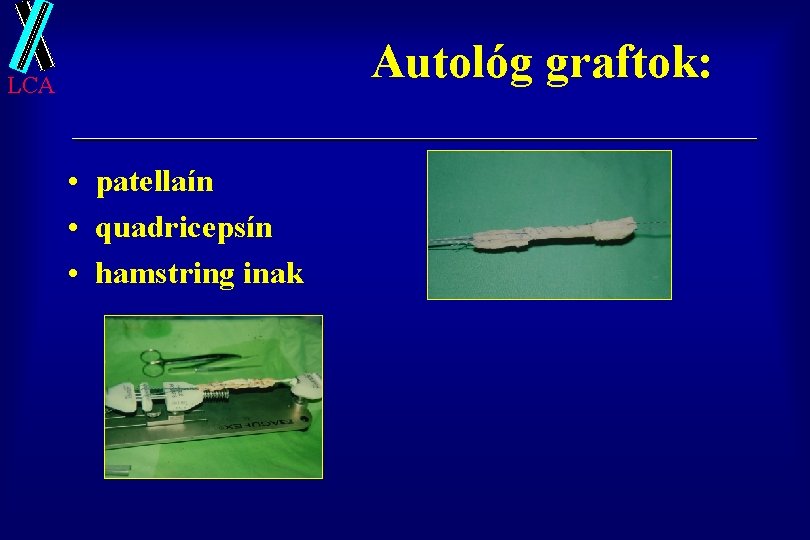 Autológ graftok: LCA • patellaín • quadricepsín • hamstring inak 