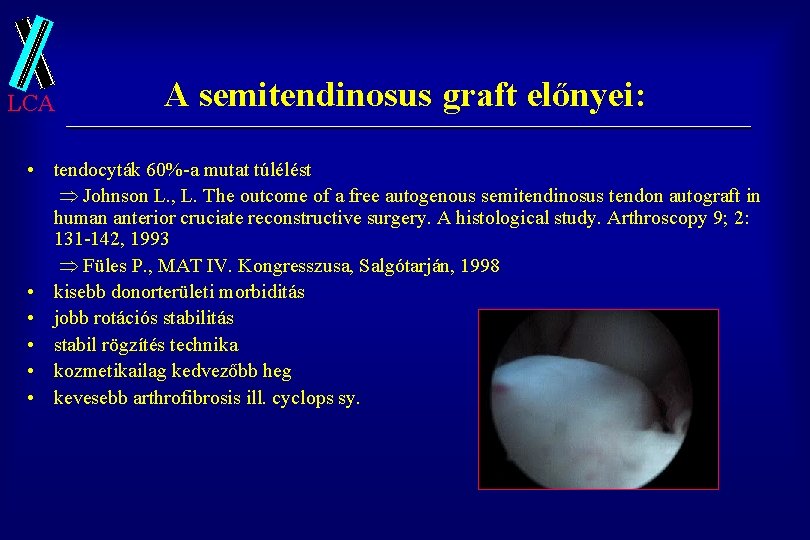 LCA A semitendinosus graft előnyei: • tendocyták 60%-a mutat túlélést Johnson L. , L.