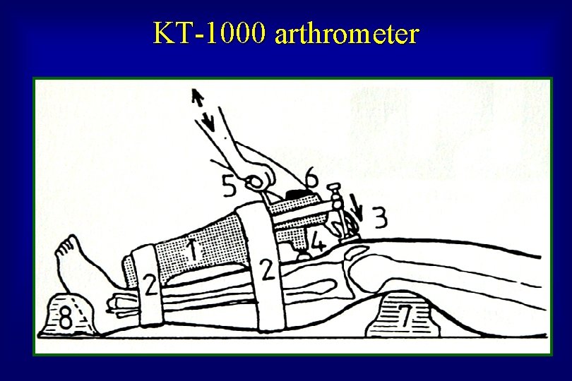 KT-1000 arthrometer 