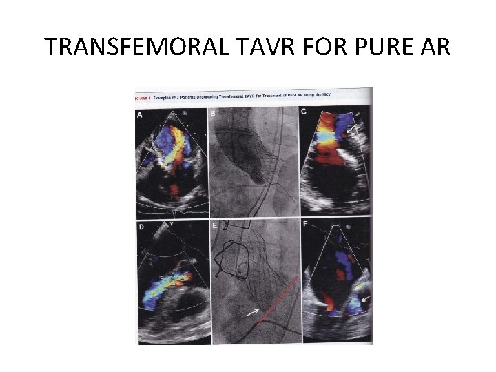 TRANSFEMORAL TAVR FOR PURE AR 