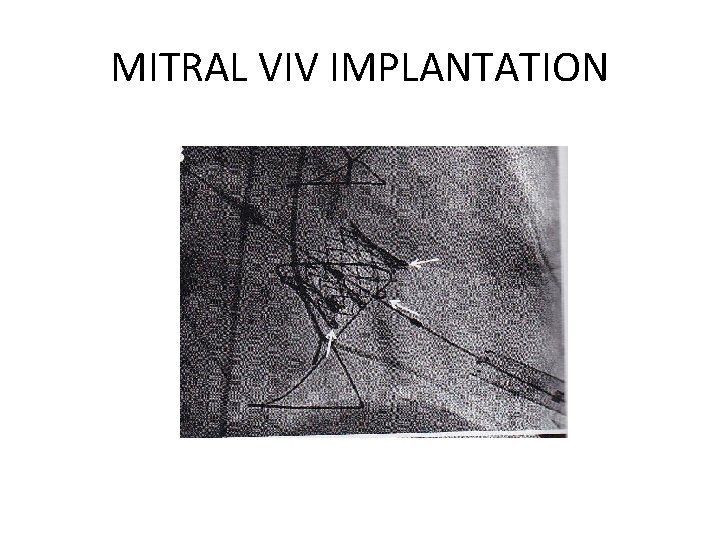 MITRAL VIV IMPLANTATION 