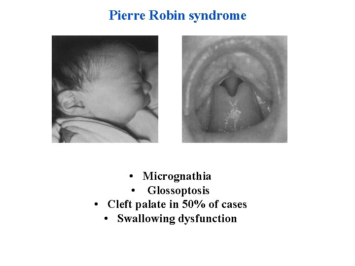 Pierre Robin syndrome • Micrognathia • Glossoptosis • Cleft palate in 50% of cases