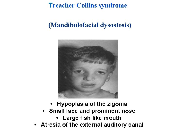 Treacher Collins syndrome (Mandibulofacial dysostosis) • Hypoplasia of the zigoma • Small face and