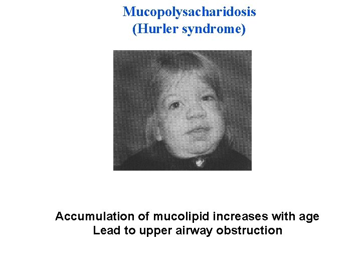 Mucopolysacharidosis (Hurler syndrome) Accumulation of mucolipid increases with age Lead to upper airway obstruction