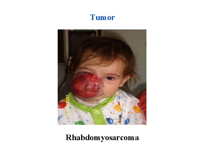 Tumor Rhabdomyosarcoma 