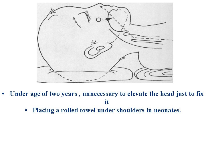  • Under age of two years , unnecessary to elevate the head just