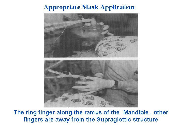 Appropriate Mask Application The ring finger along the ramus of the Mandible , other