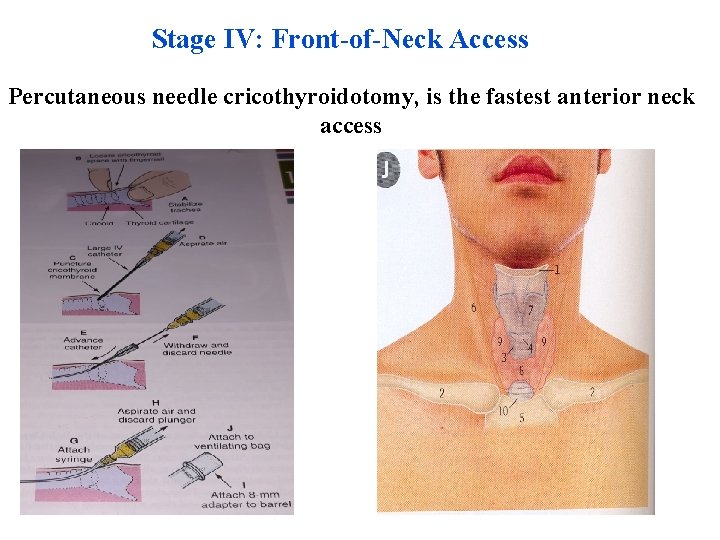 Stage IV: Front-of-Neck Access Percutaneous needle cricothyroidotomy, is the fastest anterior neck access 