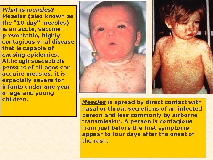 What is measles? Measles (also known as the "10 day" measles) is an acute,