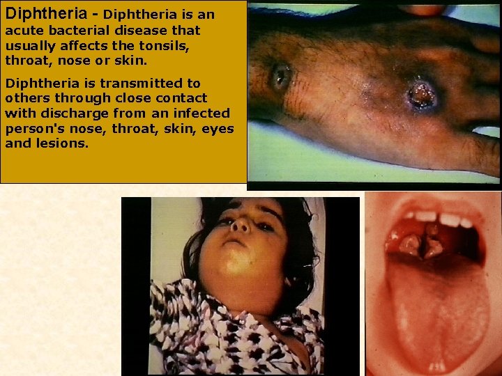 Diphtheria - Diphtheria is an acute bacterial disease that usually affects the tonsils, throat,